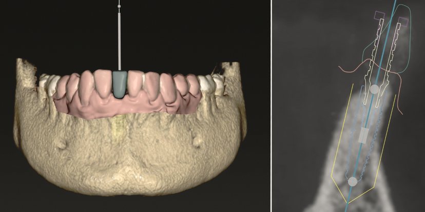 計画ソフトの画面。左に下顎の骨の立体像と計画した歯、右に CT の断面で、骨の中のインプラントの計画位置が線で示されている